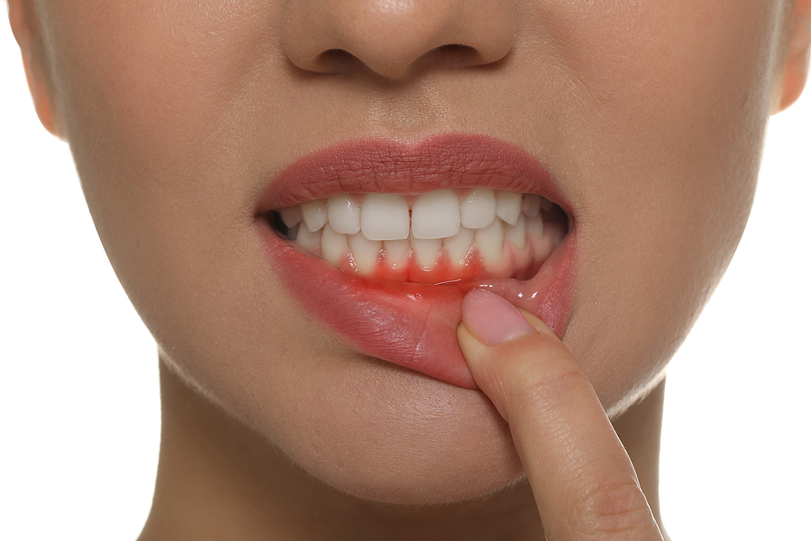 What Are the Main Causes of Gum Disease?