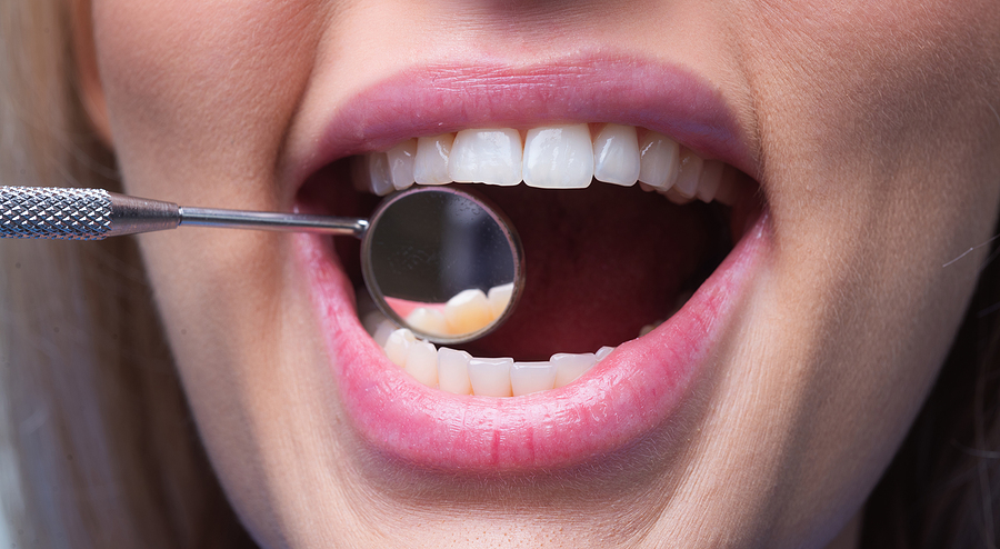 Do Dental Implants Feel Like Real Teeth? What You Need to Know