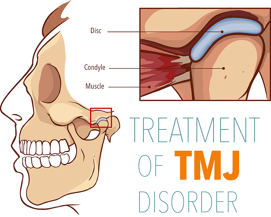 Understanding TMJ Treatment: Relieving Jaw Pain and Restoring Comfort